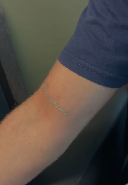 Dövme Sildirme Sonra 1