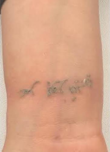 Dövme Sildirme Sonra 2