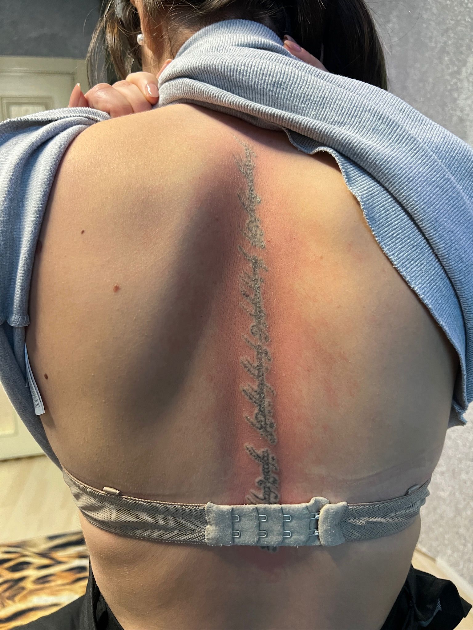 Dövme Sildirme Sonra 3