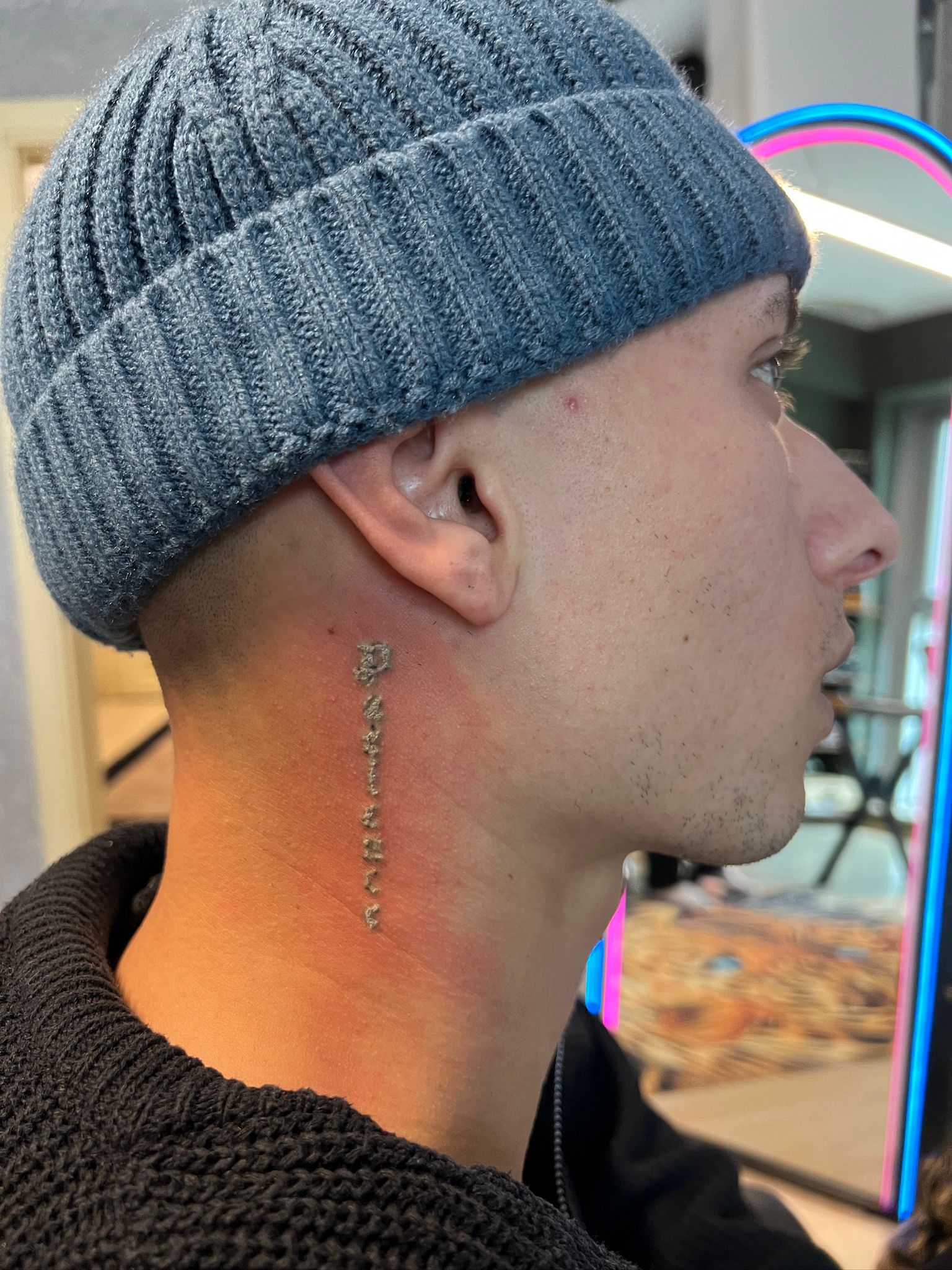 Dövme Sildirme Sonra 4