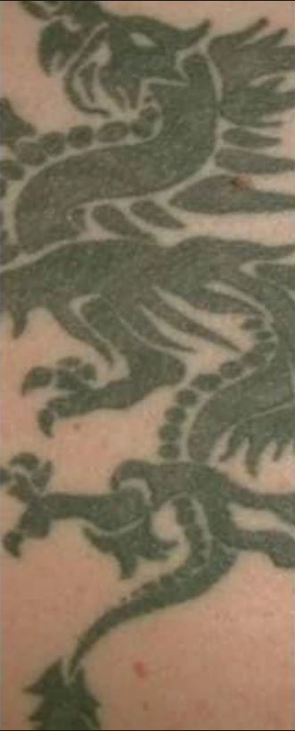 Dövme Sildirme Önce 5