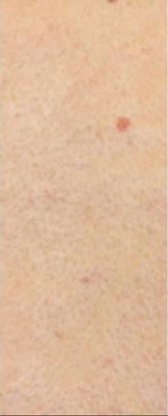 Dövme Sildirme Sonra 5