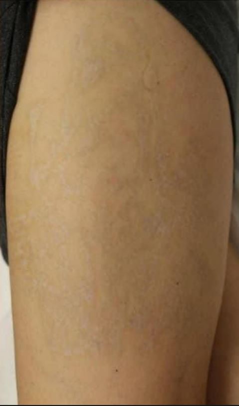 Dövme Sildirme Sonra 6